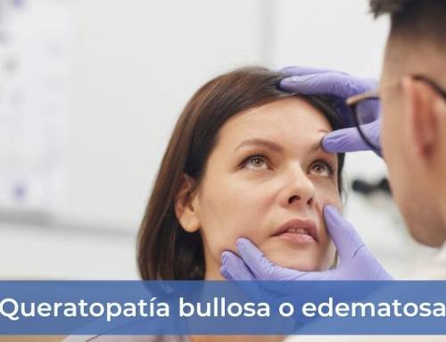 Queratopatía bullosa o edematosa